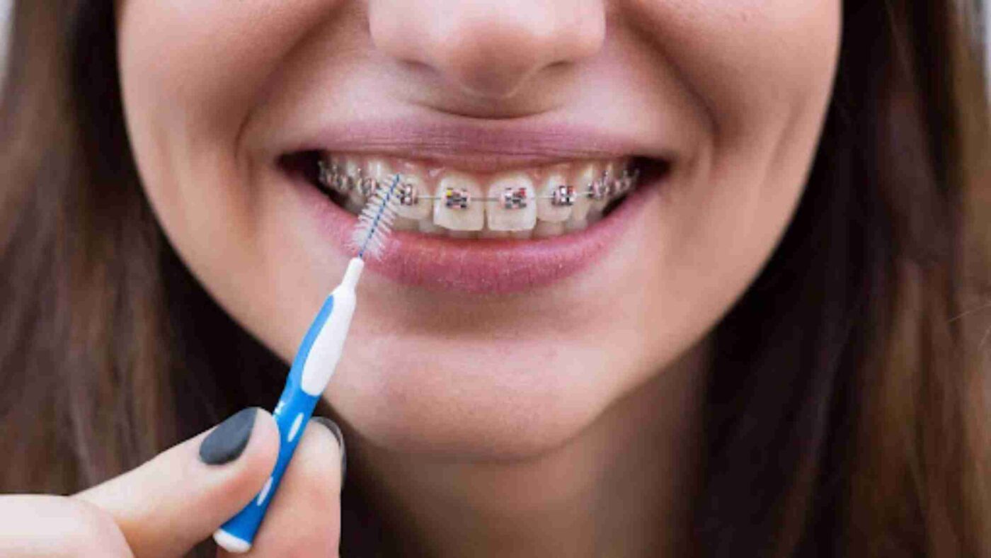 An adult woman uses a specialized orthodontic tool to remove a food particle after learning how to care for braces from her orthodontist.