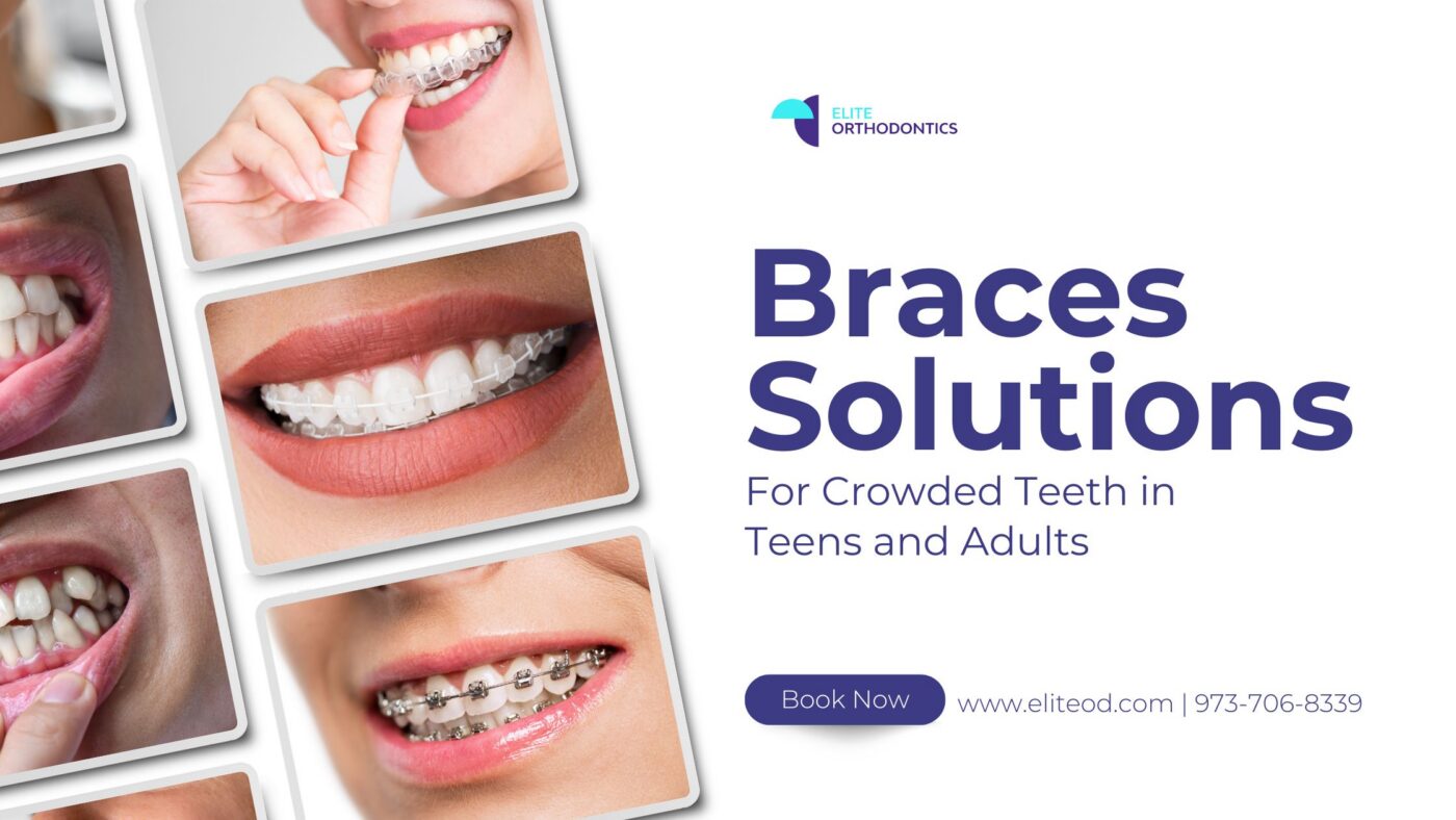 Braces Solutions for Crowded Teeth in Teens and Adults