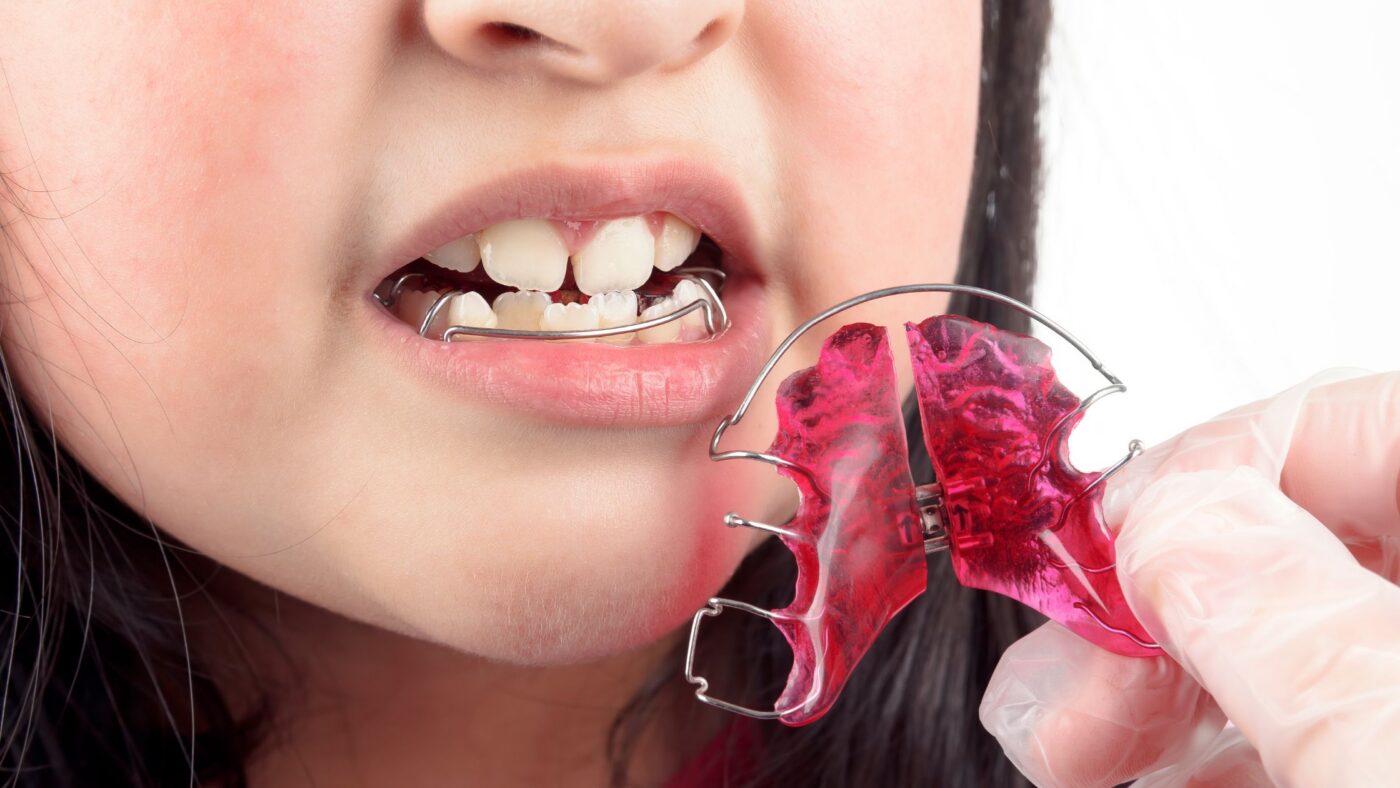 a child with retainers on