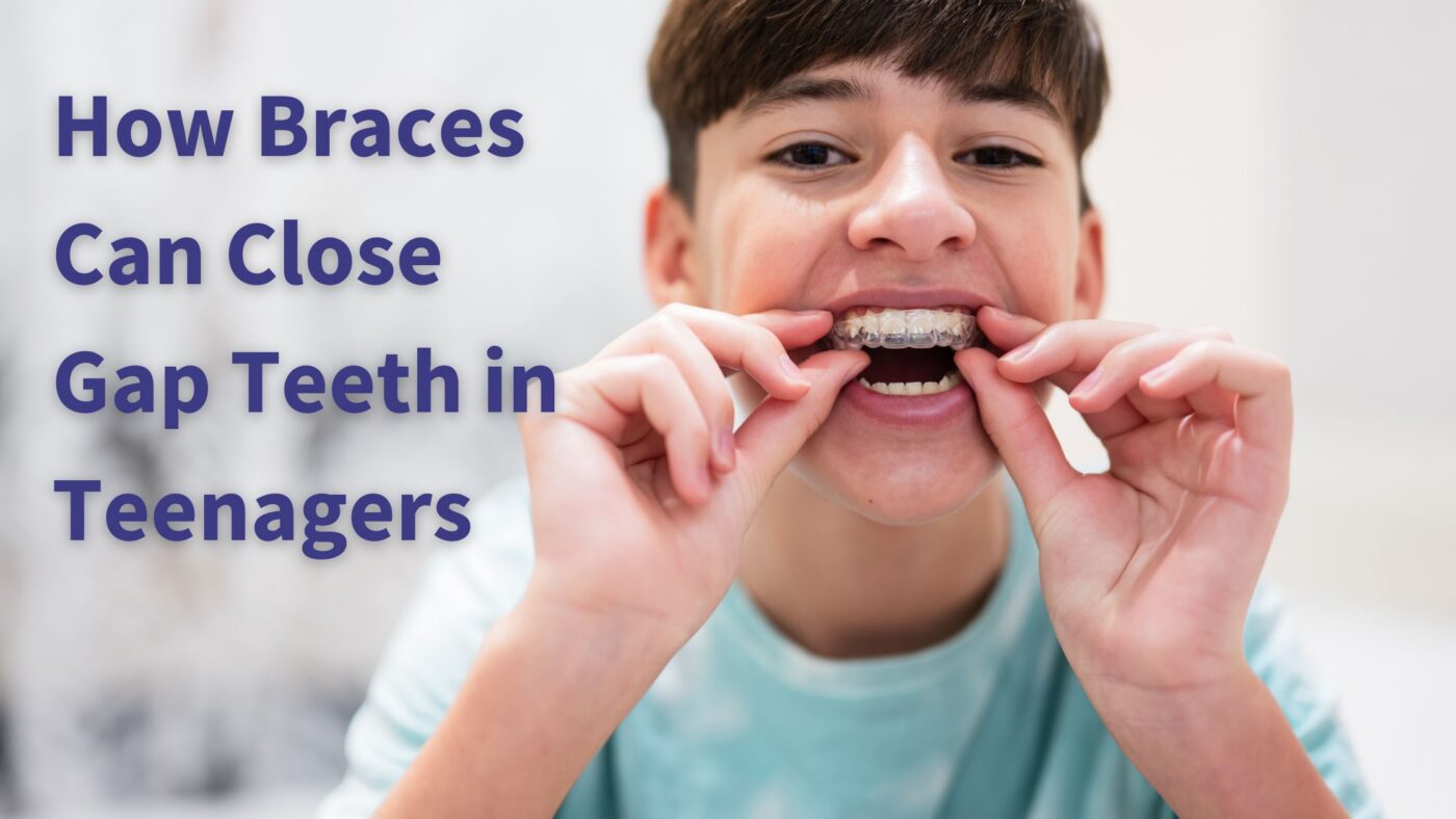 How Braces Can Close Gap Teeth in Teenagers