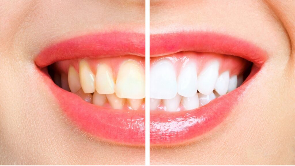 The same smile before and after professional teeth whitening