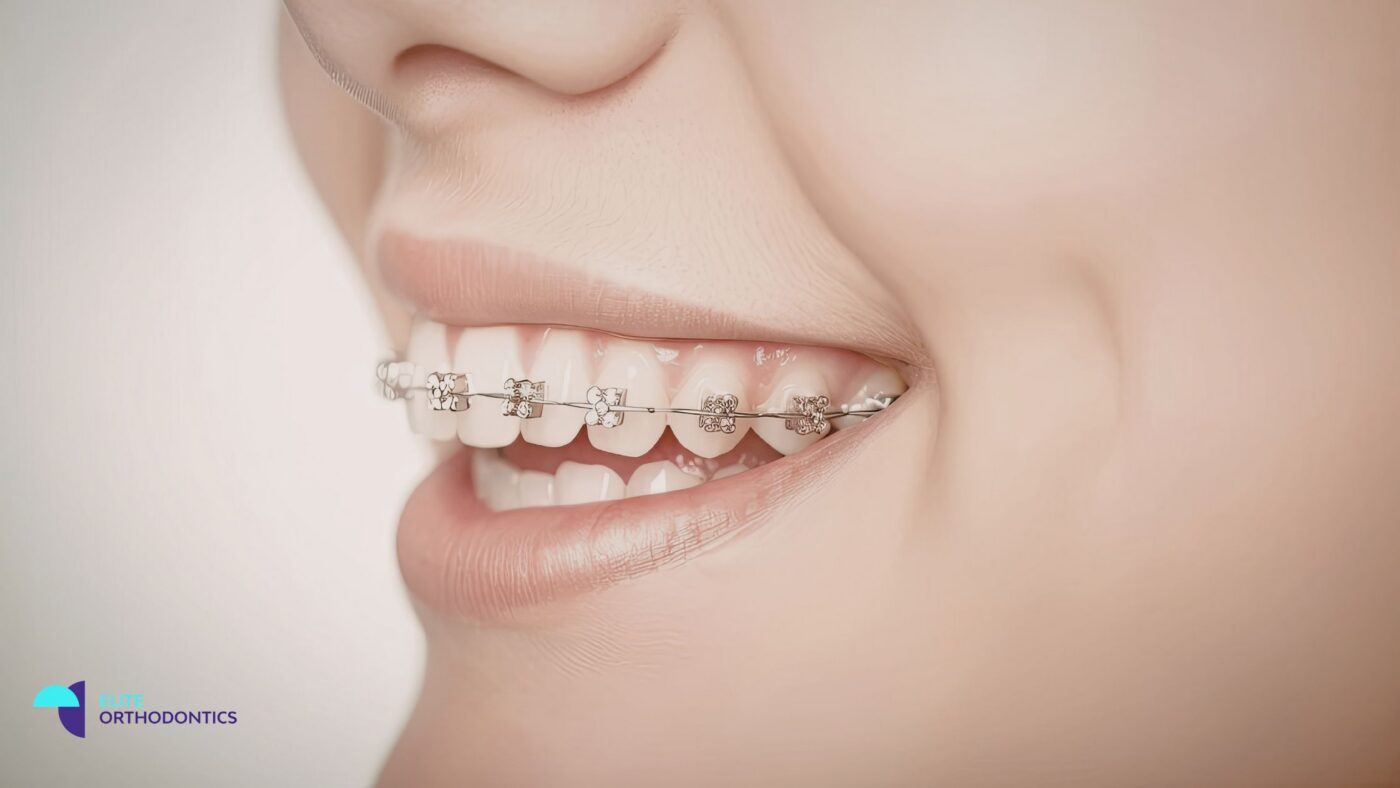 Person smiling with clear braces showing teeth alignment during orthodontic treatment