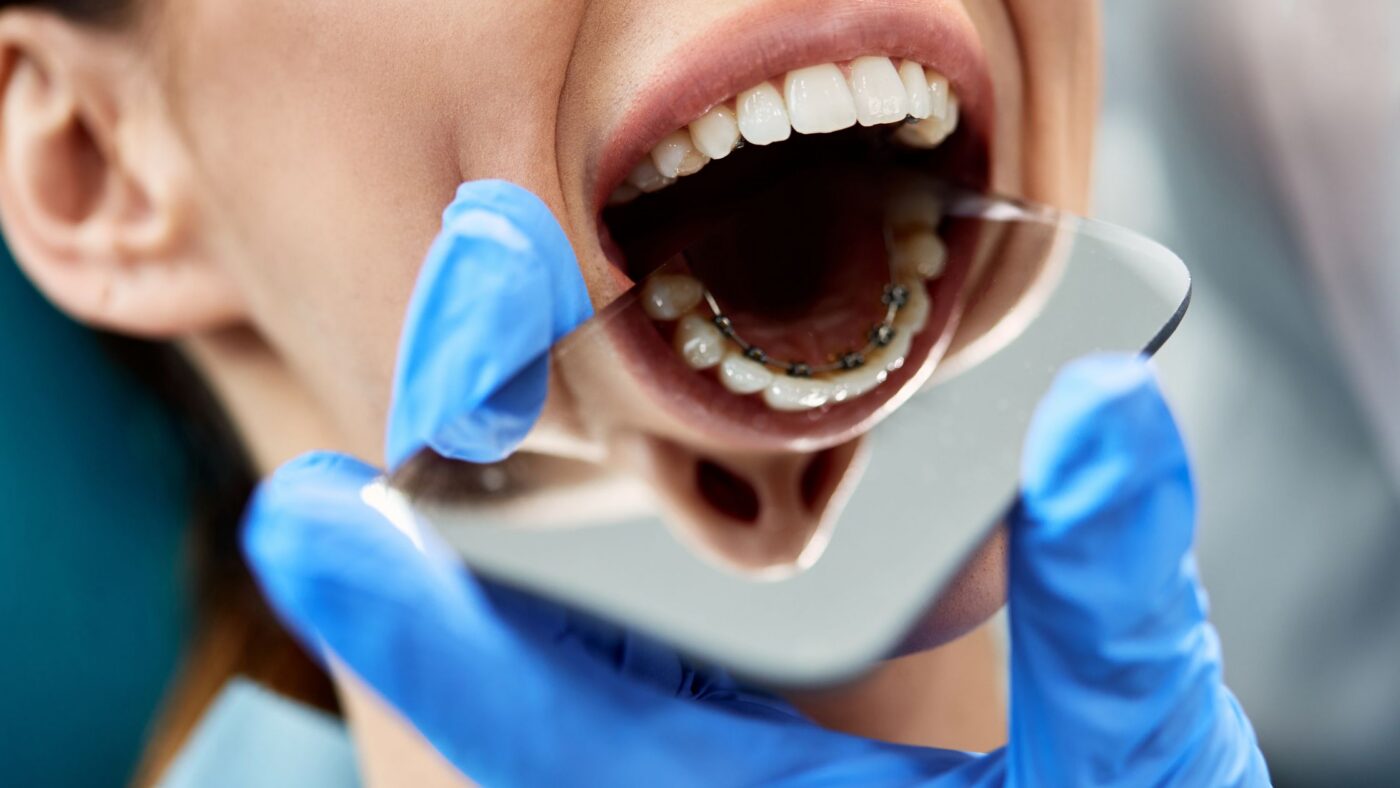 patient with lingual braces