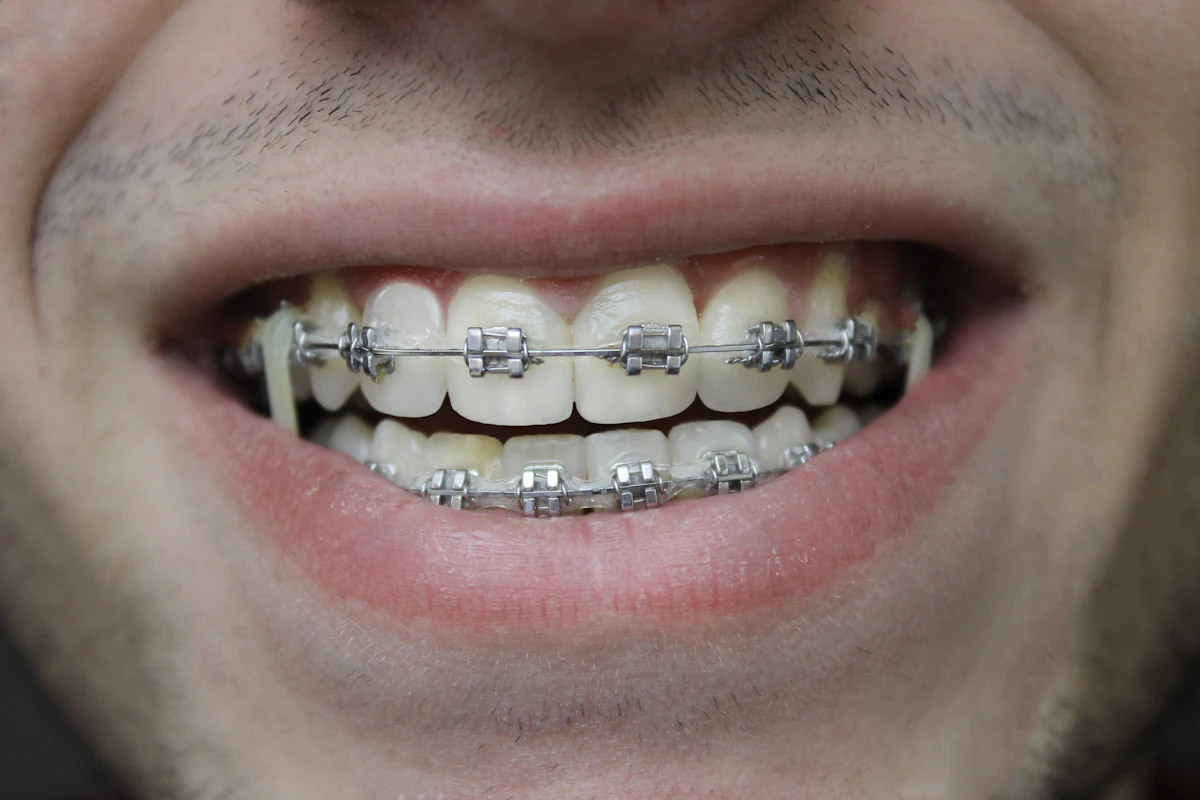 Close-up of metal braces on the upper and lower teeth